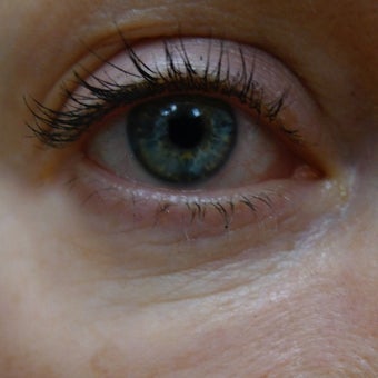 Laser and fillers- the perfect combination for wrinkle removal around the eyes. before 1812833