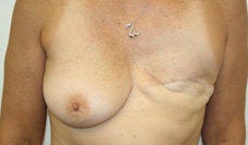Breast Reconstruction before 572279