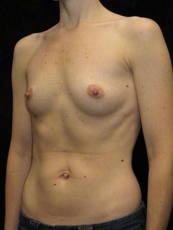 37 year old woman treated with Breast Augmentation for Fullness, Slight Asymmetry before 3103569