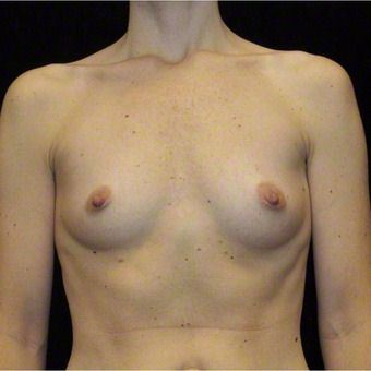 37 year old woman treated with Breast Augmentation for Fullness, Slight Asymmetry 3103569