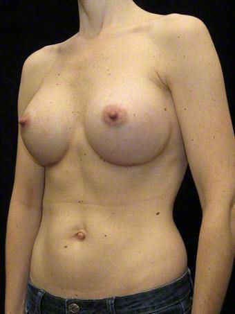37 year old woman treated with Breast Augmentation for Fullness, Slight Asymmetry after 3103569