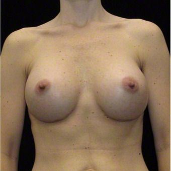 37 year old woman treated with Breast Augmentation for Fullness, Slight Asymmetry 3103569