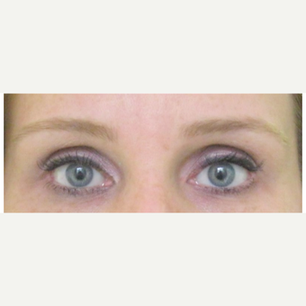 Female Treated with Brow Lift after 1984365