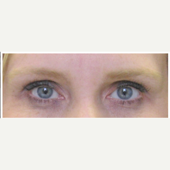 Female Treated with Brow Lift before 1984365