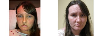 Mole Removal photos before 951883