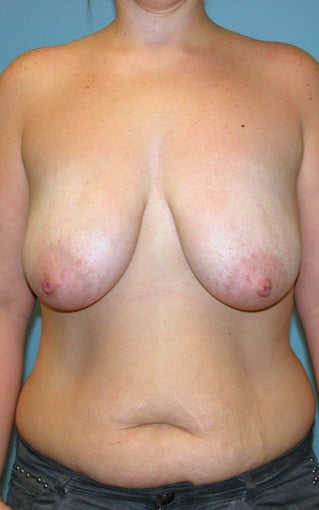 25-34 year old woman treated for Breast Lift with Implants before 1534732