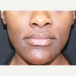 25 year old female treated with Juvederm for nasolabial folds after 3088824