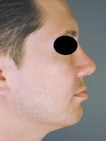 Male Chin Implant after 831866