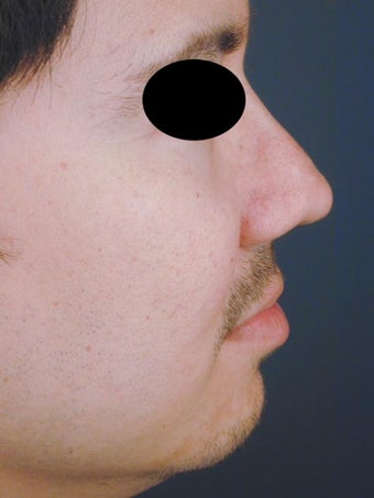 Male Chin Implant before 831866