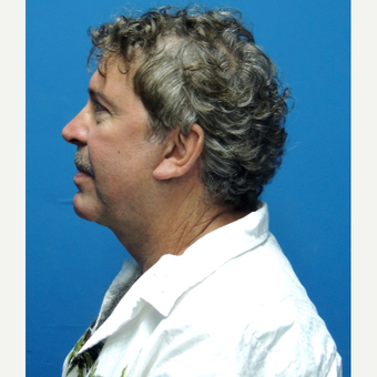 45-54 year old man treated with Facelift after 3704482