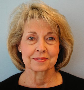 Facelift before 1214253