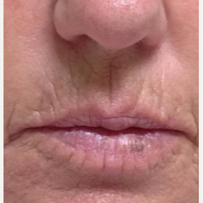 61 year old woman treated with Juvederm before 3769487