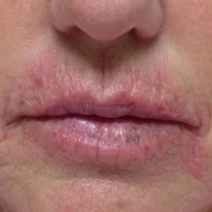 61 year old woman treated with Juvederm after 3769487
