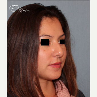 35-44 year old woman treated with Rhinoplasty before 3577985