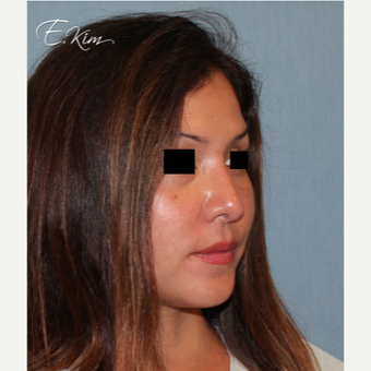 35-44 year old woman treated with Rhinoplasty after 3577985