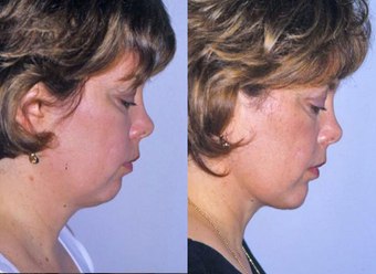 Neck Liposuction after 1182888