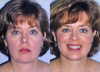 Neck Liposuction before 1182888