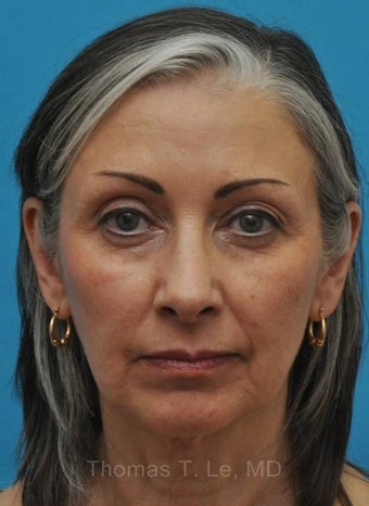 Aging face rejuvenation with Botox and Filler after 1077334