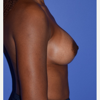 Breast Augmentation with Ideal Saline Breast Implants 350 cc after 3080181