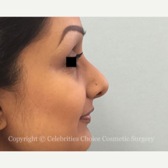 25-34 year old woman treated with Rhinoplasty before 3013586