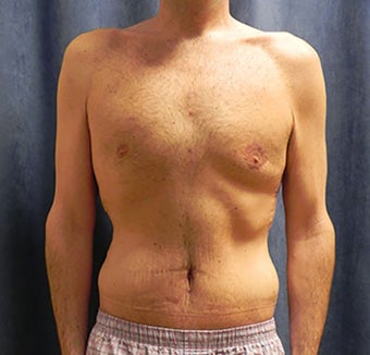 Body Lift after 1374948