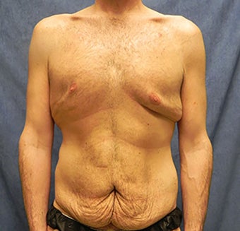Body Lift before 1374948