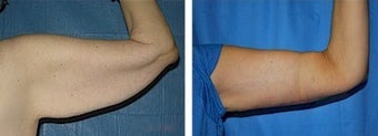 45 year old womean had Arm lift before 245242