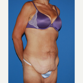 35-44 year old woman treated with Panniculectomy before 2879534