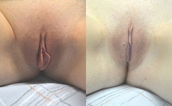 Labiaplasty before 3037823