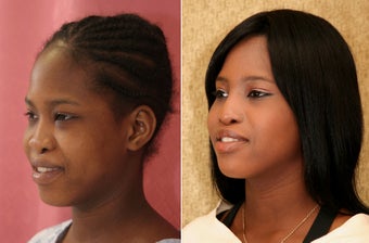 African-American Rhinoplasty 1009898