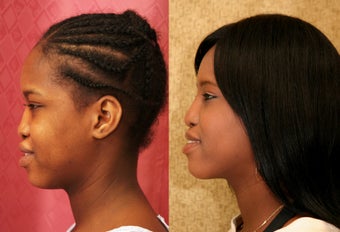African-American Rhinoplasty after 1009898