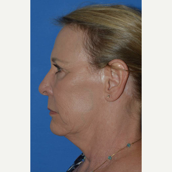 55-64 year old woman treated with Facelift before 3781984