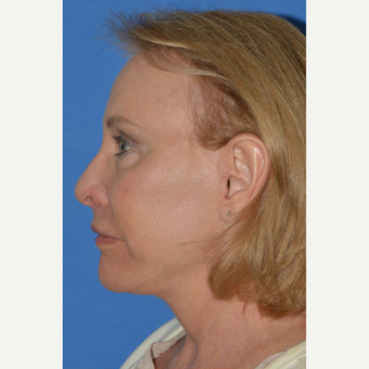 55-64 year old woman treated with Facelift after 3781984