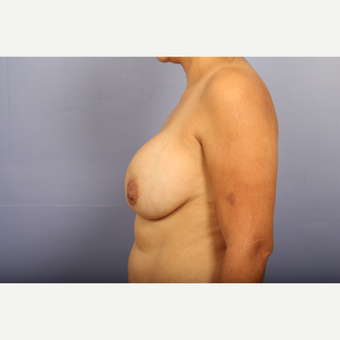 25-34 year old woman treated with Breast Lift with Implants before 3110322
