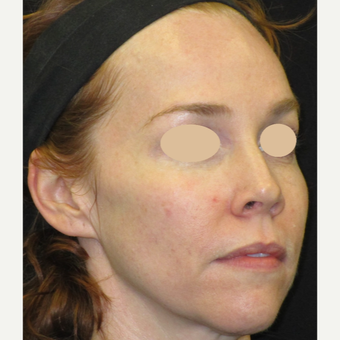35-44 year old woman treated with Laser Treatment before 3140112