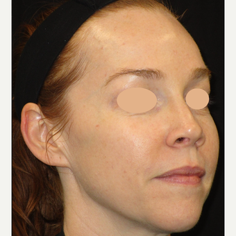 35-44 year old woman treated with Laser Treatment after 3140112