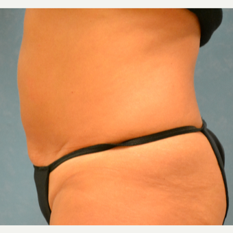 35-44 year old woman treated with Liposuction after 3731780