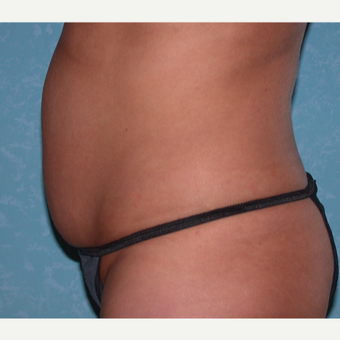 35-44 year old woman treated with Liposuction before 3731780