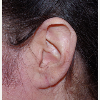 45-54 year old woman treated with Ear Lobe Surgery after 3741903