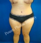35-44 year old woman treated with Tummy Tuck after 3711868