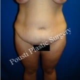 35-44 year old woman treated with Tummy Tuck before 3711868