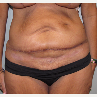 45-54 year old woman treated with Panniculectomy after 3583823