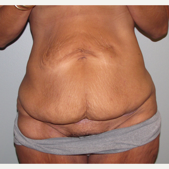 45-54 year old woman treated with Panniculectomy before 3583823