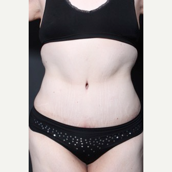 25-34 year old woman treated with Tummy Tuck after 3591276