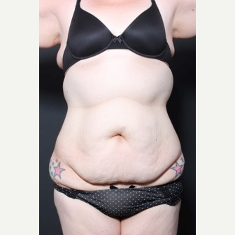 25-34 year old woman treated with Tummy Tuck before 3591276