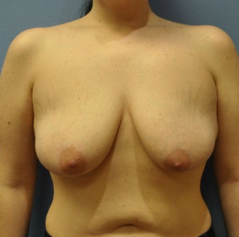 Breast Augmentation, Breast Implants, Mastopexy, Breast Lift before 1206558