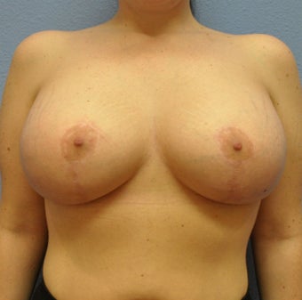 Breast Augmentation, Breast Implants, Mastopexy, Breast Lift after 1206558