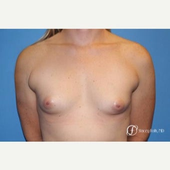 35-44 year old woman treated with MTF Breast Augmentation with Sientra Textured Breast Implants before 2656059