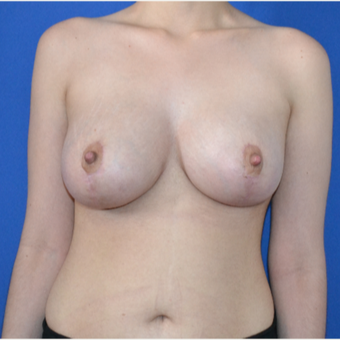 25-34 year old woman treated with Breast Lift after 3466559