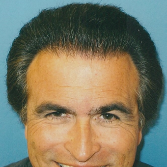 45-54 year old man treated with Hair Transplant after 3495102